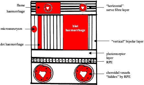 Dot and Blot Haemorrhages diagram