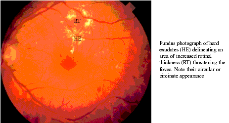 Hard Exudate Formation photo