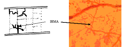 Intra-retinal microvascular anomalies diagram & photo