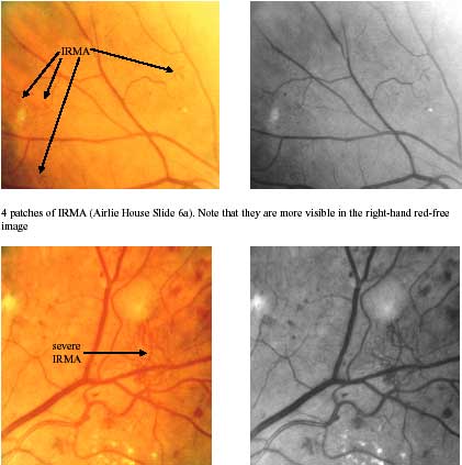 Intra-retinal microvascular abnormalities photo