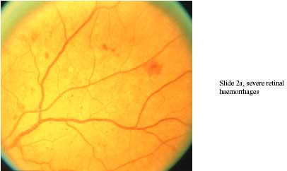 slideIntra-retinal microvascular abnormalities chart