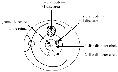Macular Oedema diagram