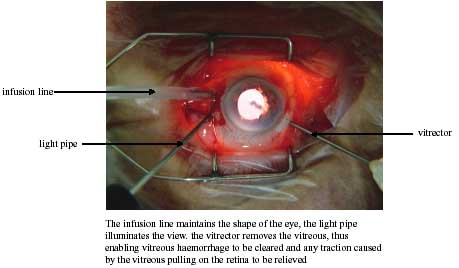 Persistent Vitreous Haemorrhage and Traction Retinal Detachmen photo