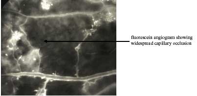 Occluded Capillaries photo