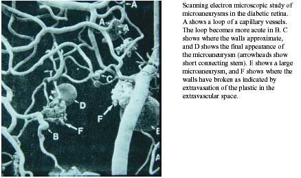 Microaneurysms photo