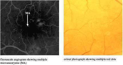 Microaneurysms photo