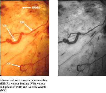 intra-retinal microvascular abnormalities photos