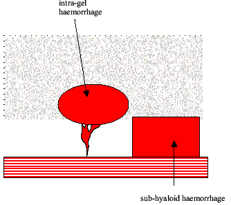 vitreous gel bleeding diagram