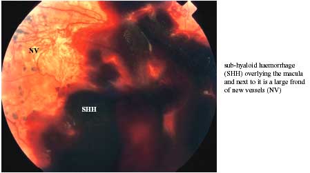 pre-retinal or sub-hyaloid haemorrhage photo