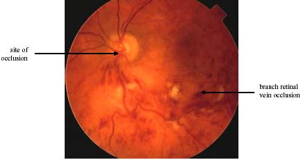 Retinal Vein Occlusion photo