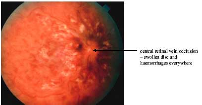 Retinal Vein Occlusion photo