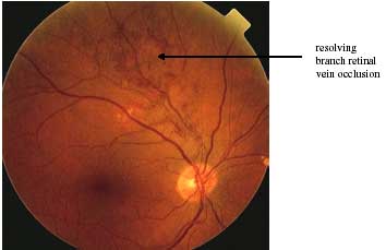 pictureRetinal Vein Occlusion photo