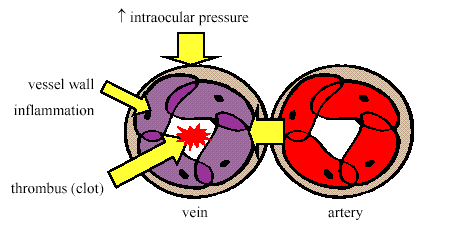Retinal Vein Occlusion diagram