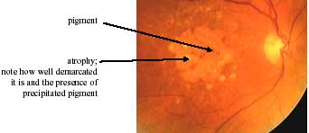 Atrophic Age-Related Macular Degeneration photo
