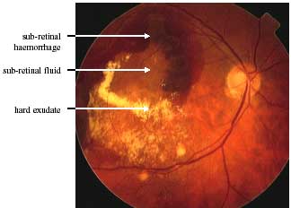 Choroidal Neovascular Membrane formation photo