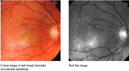 Choroidal Neovascular Membrane formation photo