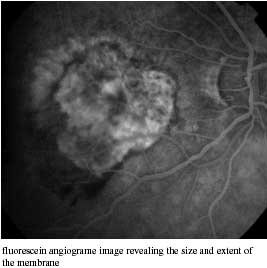 Choroidal Neovascular Membrane formation photo