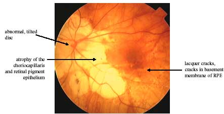 Pathological Myopia photo
