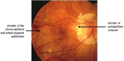 Chorioretinal atrophy photo