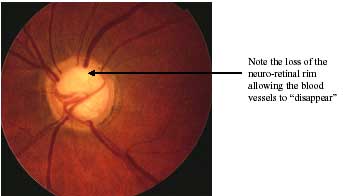 Glaucoma photo