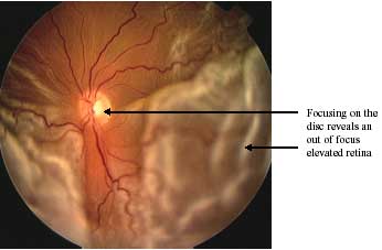 Retinal Detachment photo