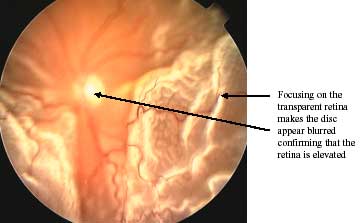 Retinal Detachment photo