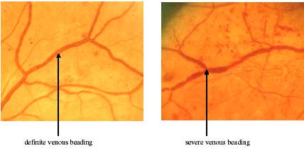 venous beading photo