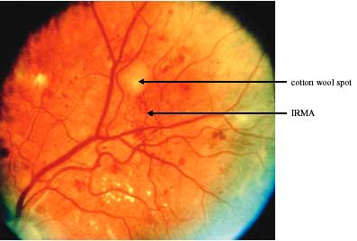 Haemorrhages and/or Microaneurysms photo