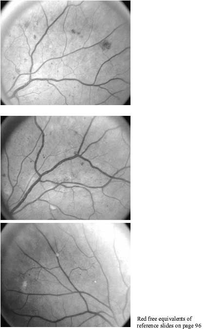 Referable Retinopathy photos