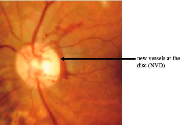 PROLIFERATIVE RETINOPATHY photo