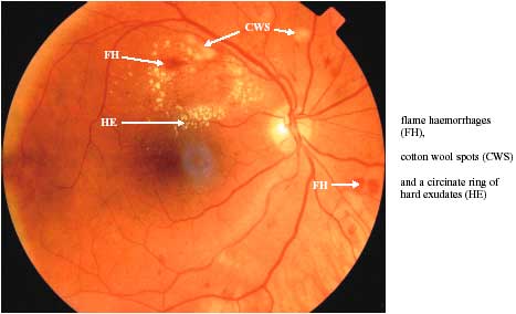 DIABETIC MACULAR OEDEMA photo