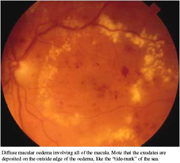 DIABETIC MACULAR OEDEMA photo