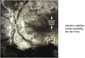 DIABETIC MACULAR OEDEMA photo