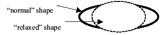 myopia diagram