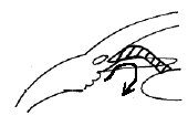 Angle Closure Glaucoma diagram