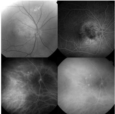 INDOCYANINE GREEN ANGIOGRAPHY photo