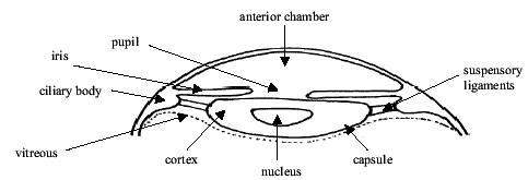 cataract diagram