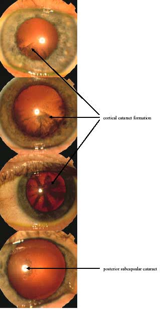 cataract photos