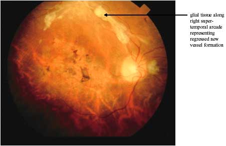 Proliferative Retinopathy photo